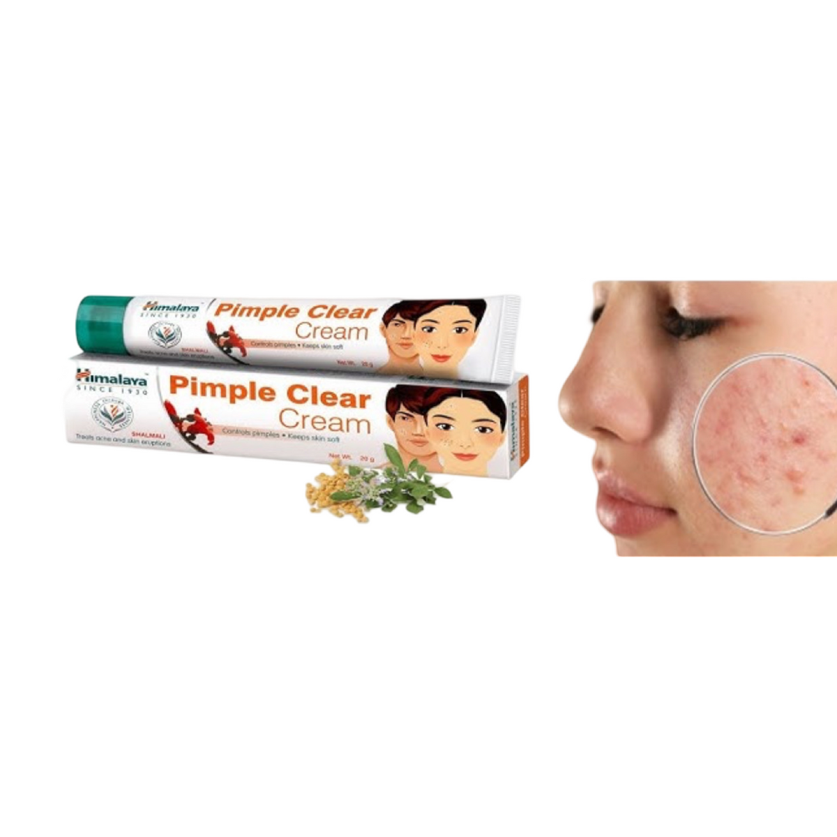 Himalaya Acne Pimple Cream – Ayurvedic Spot Treatment for Clear Skin