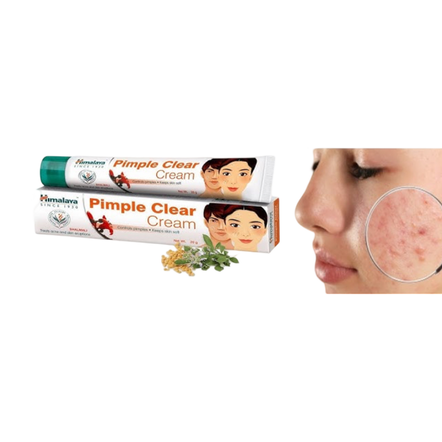 Himalaya Acne Pimple Cream – Ayurvedic Spot Treatment for Clear Skin